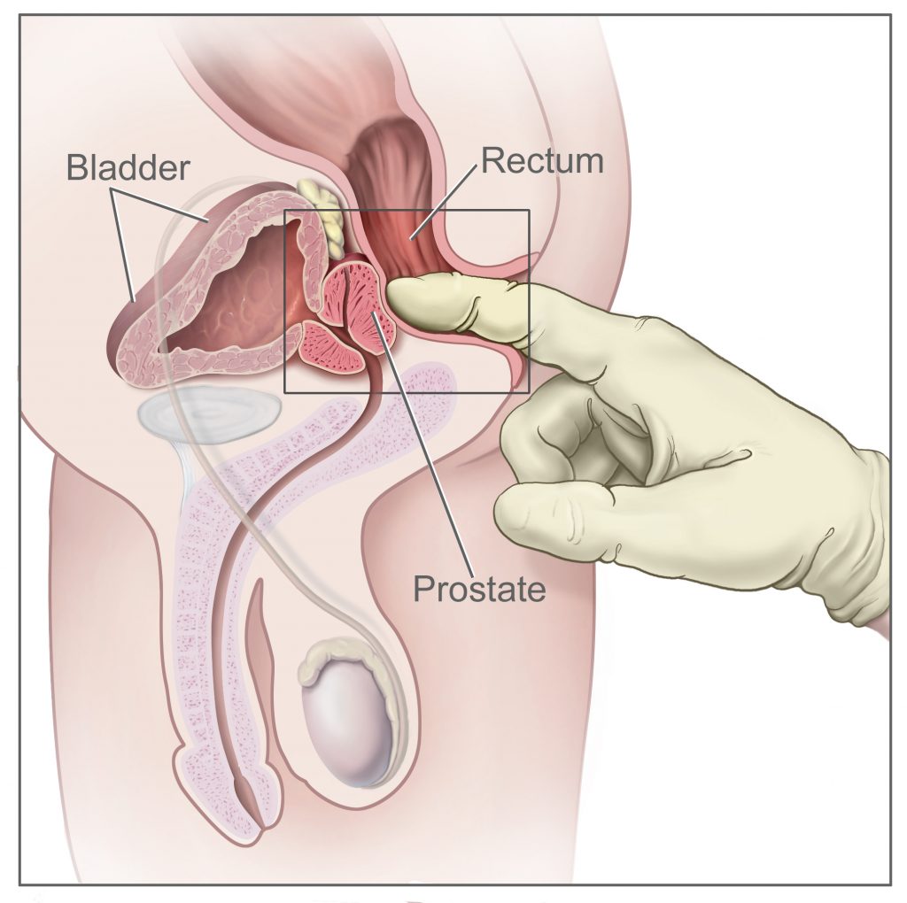 Prostatic fluid no orgasm