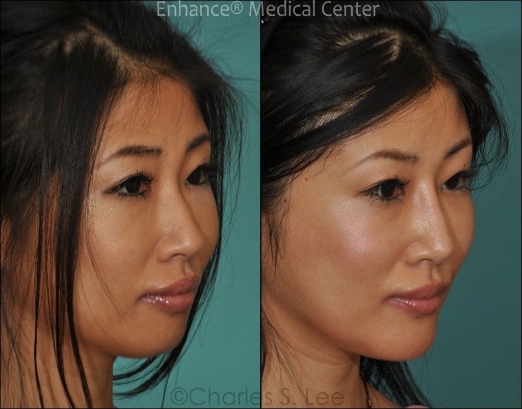 Coma reccomend nose implants Asian
