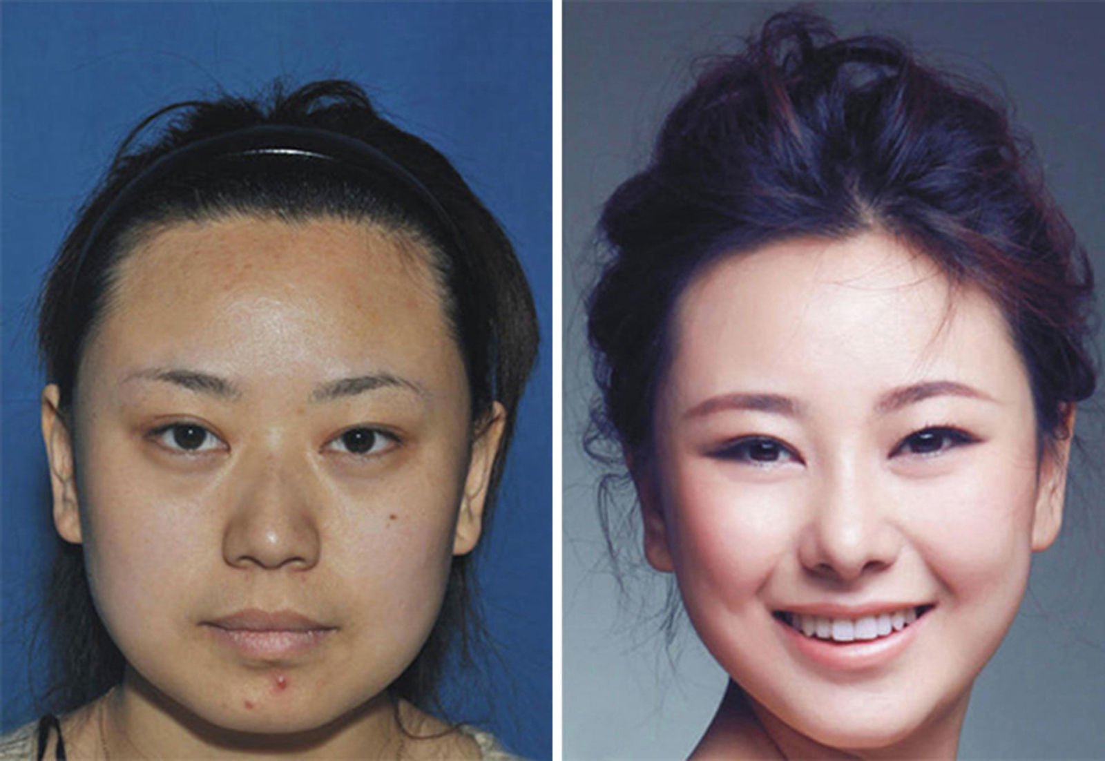 Asian nose implants