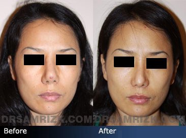best of Nose implants Asian